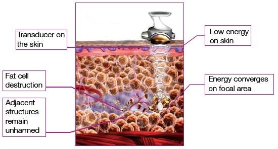 China leading technology most professional hifu slimming devices HIFUSHAPE hifu doublo hiron co