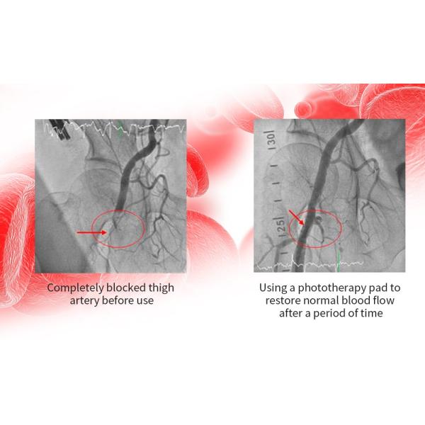 Пусковая площадка терапией инфракрасного света