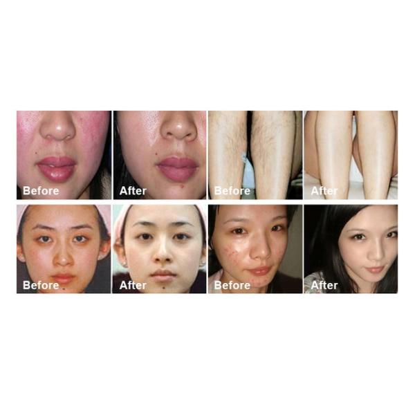 IPL OPT Laser Hair Removal Machine 3000W E-Light IPL Beauty Equipment