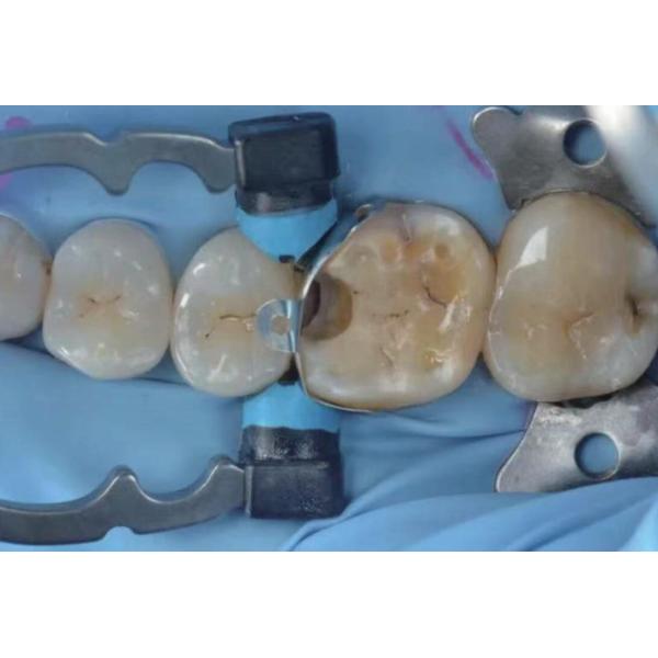 Tofflemire Matrix Band Holder Dental A3 Bands Clamp Ring Resin