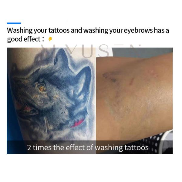 Q Switched Nd Yag Picosecond Laser Tattoo Removal Machine Skin Whitening