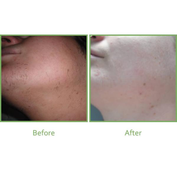 Acne Therapy Ipl Skin Rejuvenation Equipment  , IPL Beauty Machine Big Handle 15 * 50mm