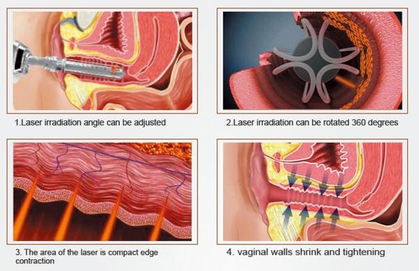 Dispositivo fracionário do laser do CO2 médico para a pele da remoção da cicatriz que Resurfacing o aperto