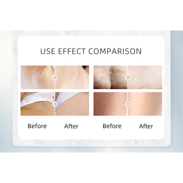 OEM Alexandrite 808NM Diode Laser Machine Permanent Hair Removal