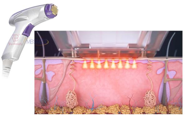 Máquina de aperto de pele de radiofrequência de micro-agulha de RF fracionada