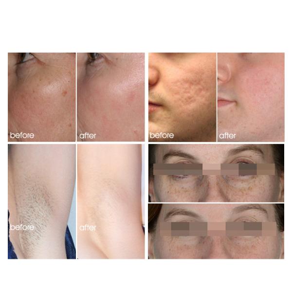 ADSS Newest IPL Hair Removal Machine Intensive Pulse Light for Skin Rejuvenation Acne Therapy Wrinkle Removal Therapy