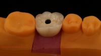 Screw Retained PFZ Porcelain Layered Zirconia Dental Implant Crown from Dental Lab ISO FDA CE Certified with 5-Year Guarantee