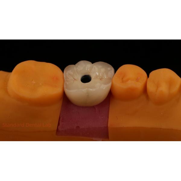 Screw Retained PFZ Porcelain Layered Zirconia Dental Implant Crown from Dental Lab ISO FDA CE Certified with 5-Year Guarantee