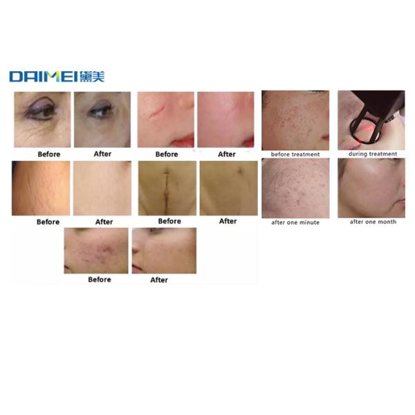 Portable CO2 Fractional Laser Machine For Acne Pigment Removal 10600nm Wavelength