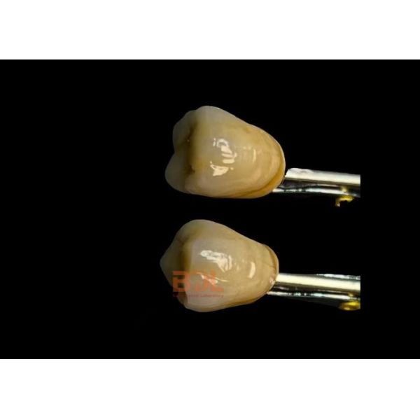 Strong Metal Ceramic Bond Porcelain Fused To Metal Dental Restoration Good Biocompatibility