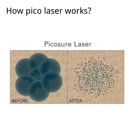 Pico laser tattoo removal machine