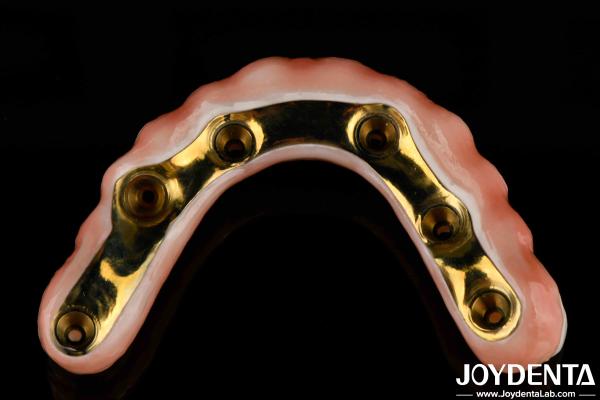 Barre de titane de longue durée Zirconia pont hybride d' apparence naturelle esthétique pour la restauration