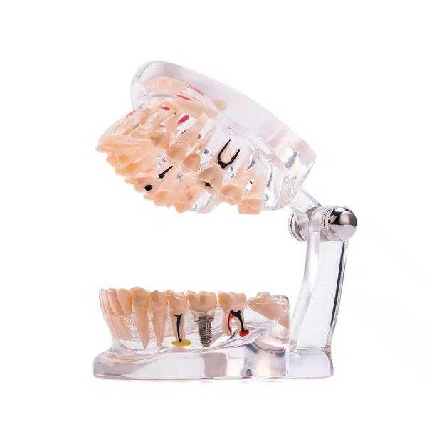 32 Tooth Full Month Implant Disease Teeth Model Clear Design  Dental Pathology Model