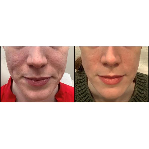 Serrage de la machine partielle de beauté de laser de CO2 de peau pour le retrait de cicatrice de colorant d'acné