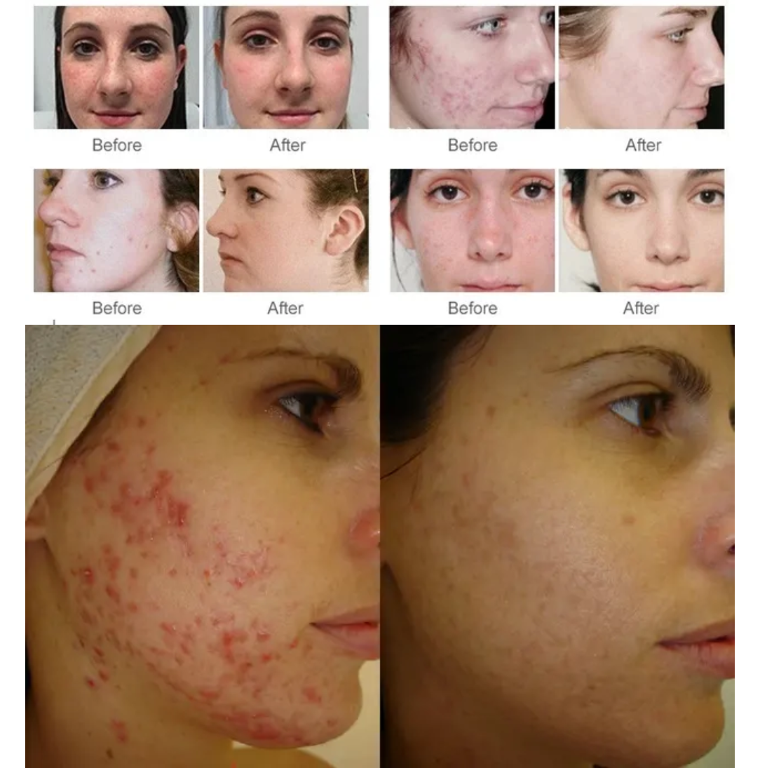 840 LED PDT Machine , Skin Treatment Photon Therapy Machine 1200W
