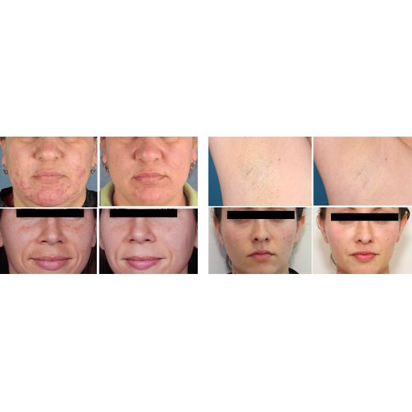 High Efficiency Salon Laser Hair Removal System Equipment Patented FCA Technology