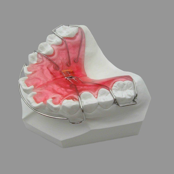 Screw Removable Expansion Plate With Stainless Steel Acrylic Materials