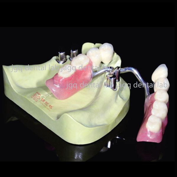 Telescope Dental Crowns High Precision Milled Precision Attachments With Acrylic Teeth Set Up