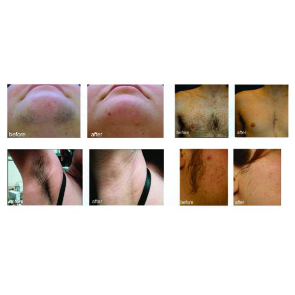 TUV Approved Laser Removal Equipment Alexandrite  For Women 2000W Peak Power