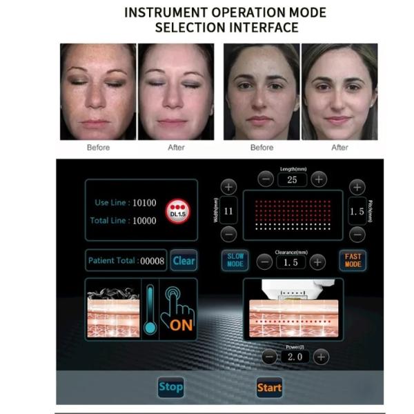 Vertical Hifu High Intensity Ultrasound Focused Korea Hifu Therapeutic Ultrasound Wrinkle Removal Face Lifting Machine