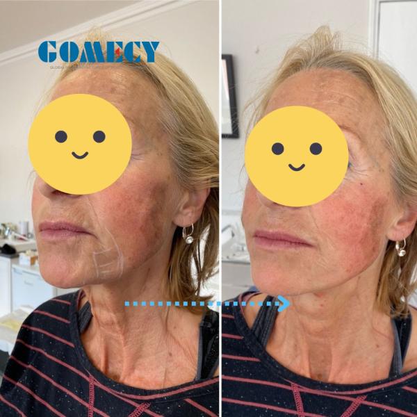 Endolift Laser Machine Double Chin and Lipolysis/Liposuction Fat Melting with 980nm 1470nm 635nm Wavelengths Treatment