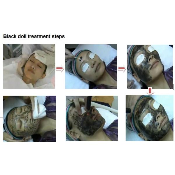 6 мм YAG Bar Q Switch Лазерная машина для удаления татуировок 1064nm 532nm 1320nm