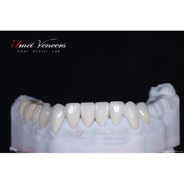 Strong and thin aesthetic veneers