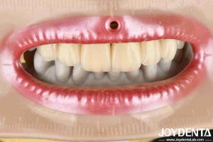Layered Zirconia High Aesthetics Excellent Biocompatibility Sintering Temperatur