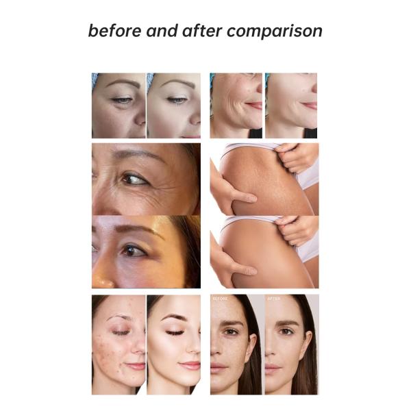 Cool Plasma Machine For Wrinkle Removal Skin Rejuvenation Body Care