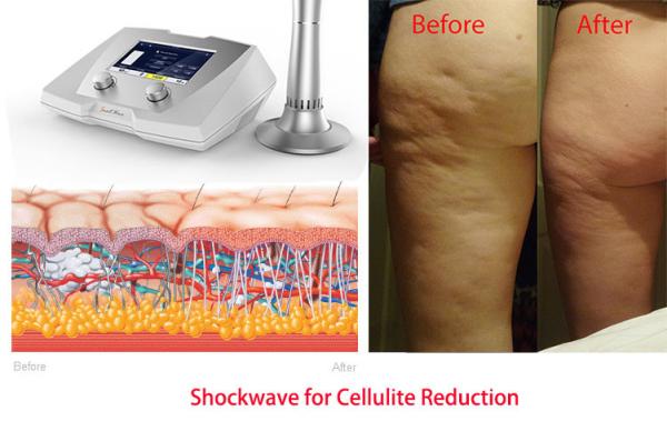 body slimming equipment Acoustic Wave therapy machine body reshaping body slimming cellulite remov