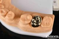 Matériau métallique, couronne dentaire en or, couronne dentaire en or pour une réhabilitation buccale optimale.