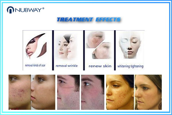 Fractional CO2 Laser 40W 10600nm Glass pipe Skin resurfacing machine for beauty spa