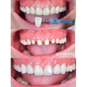 Dentaduras de zirconia que imitan los dientes naturales