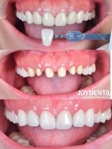 Dentaduras de zirconia que imitan los dientes naturales