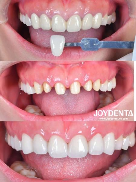 Prothèses en zirconium qui imitent les dents naturelles