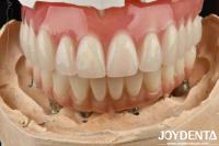 Good Elasticity Dental Acrylic Denture Finish With Tooth Arrangement Technology