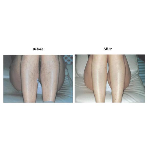 Permanent Diode Laser Hair Removal Machine For Skin Rejuvenation