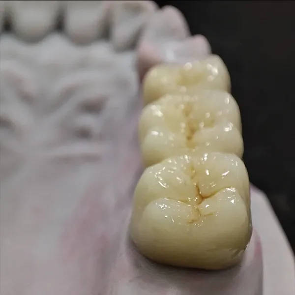 Zirconia Dentures Teeth Dental Lab Single Crown Anterior Posterior Dental Restoration