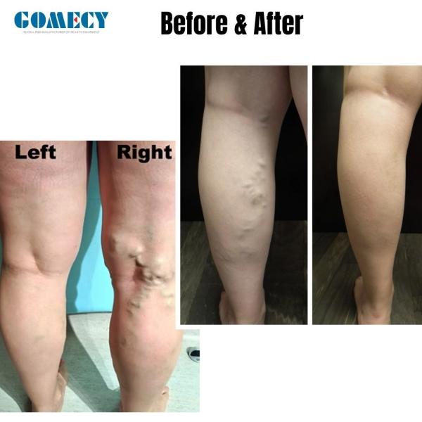 1940nm Diode Laser For Varicose Vein Removal Varicose Veins Laser Machine EVLT 1940 Varicose Veins Laser Treatment