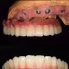 CE FDA Certified Superior Quality and Performance Dental Implants Zirconia Crowns and Customized Titanium Abutment