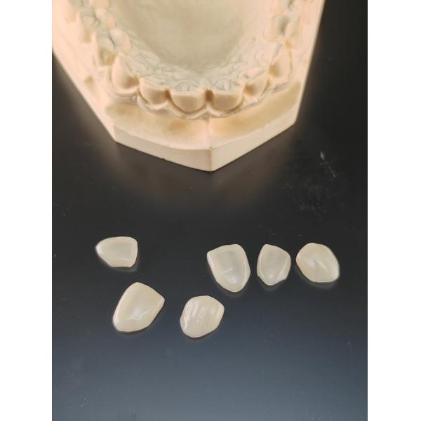 Restorative Composite Veneer INLAY ONLAY With Enhanced Longevity