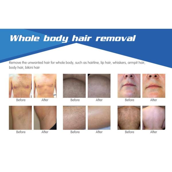 2016 NEW germany laser bar 600W power 808 diode laser hair removal painless permanent equipment