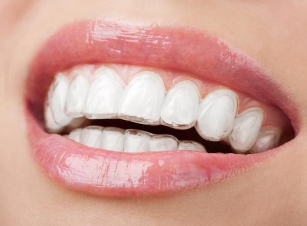 Advanced Technology And Stable Physical Properties Foil Roll For Making Aligners