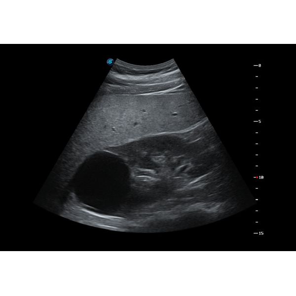 500GB Spatial Compound Imaging SonoScape Ultrasound Machine P25