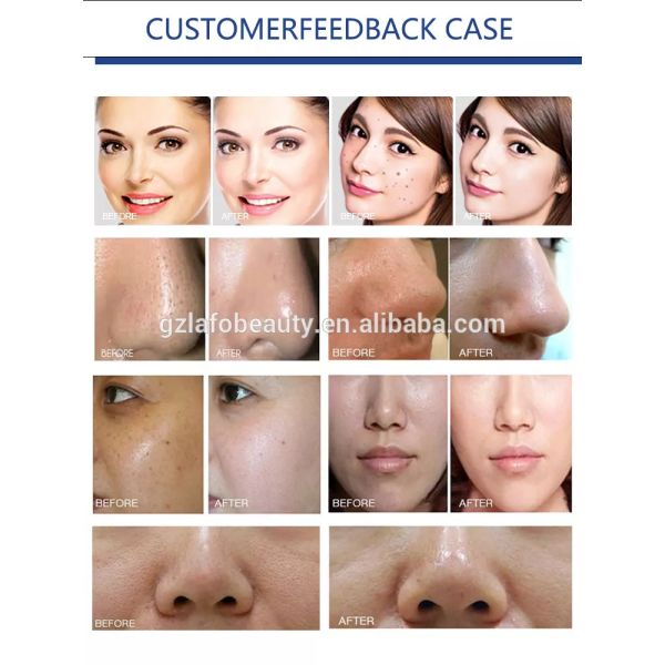 Best selling multifunction facial care microdermabrasion machine for sale