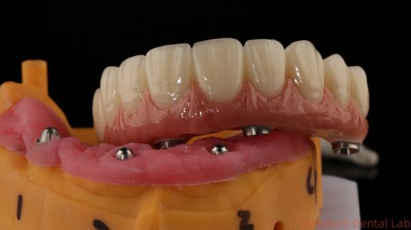 Professional Zirconia Dental Implant Crown Titanium CAD CAM Zirconia Crown China Dental Lab
