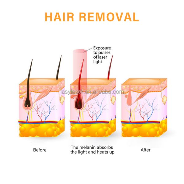 Машина удаления волос лазера диода 808 постоянная, машина депиляции лазера косметологии