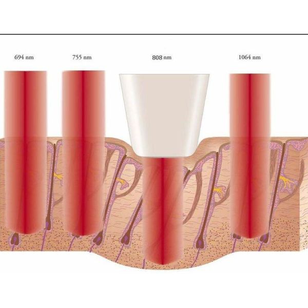 Удаление волос на лице различной машины удаления волос лазера диода обслуживания зоны мужское