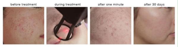 new 10.4 inch touch color screen USA Coherent laser skin resurfacing / scar removal fractional CO2 laser system
