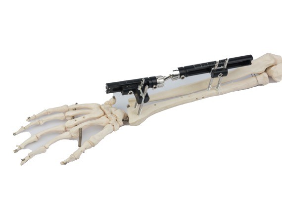 Простерилизованный радиус внешнее Fixator перелома кости дистальный